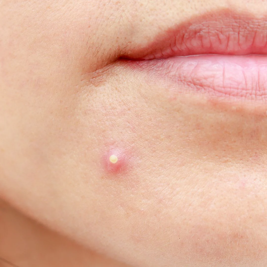 How to Choose the Right Pimple Patch (And When Each One Works)