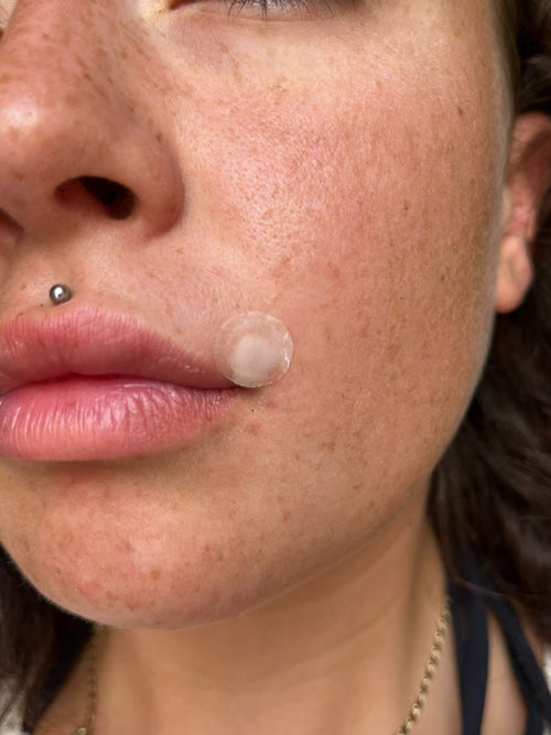 How Long Should You Leave Hydrocolloid Patch On? - Skin Choice