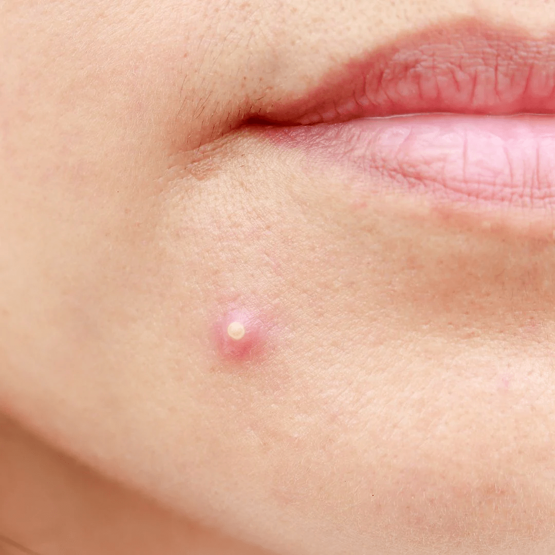 How to Choose the Right Pimple Patch (And When Each One Works) - Skin Choice