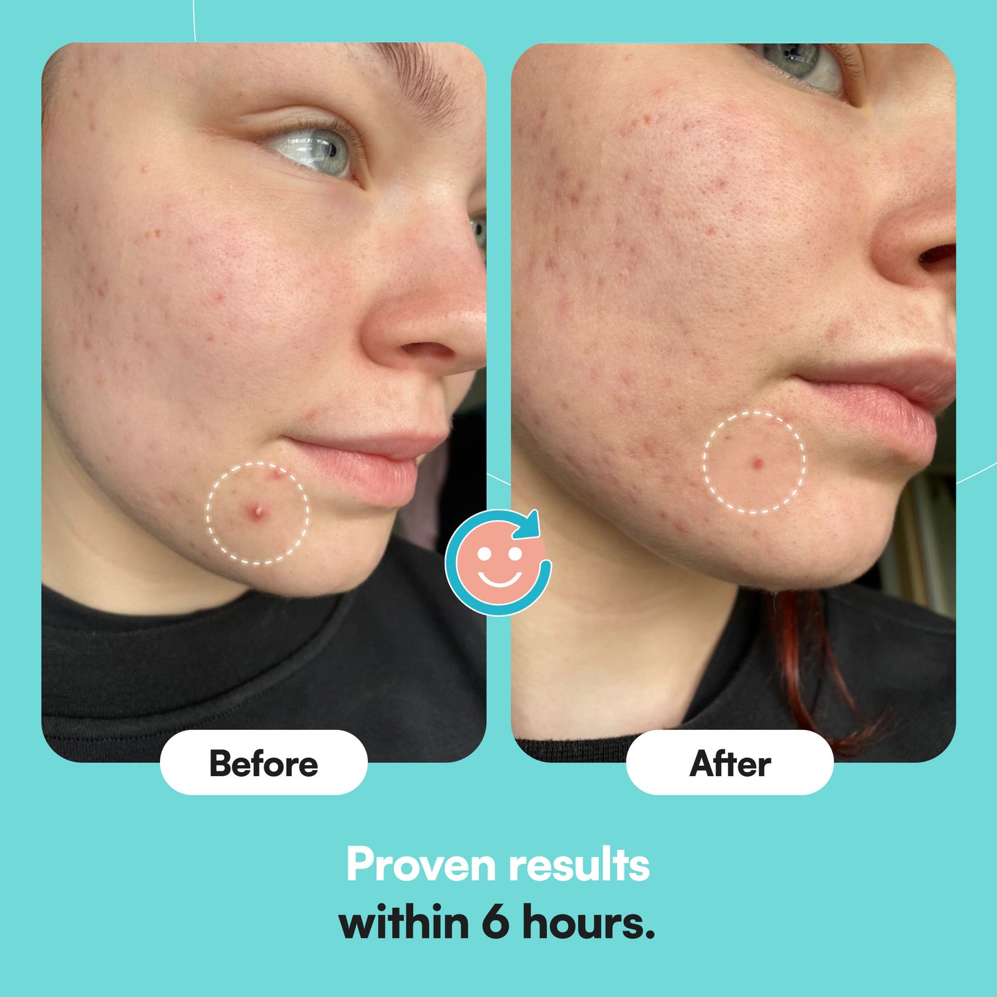 hydrocolloid patches before and after